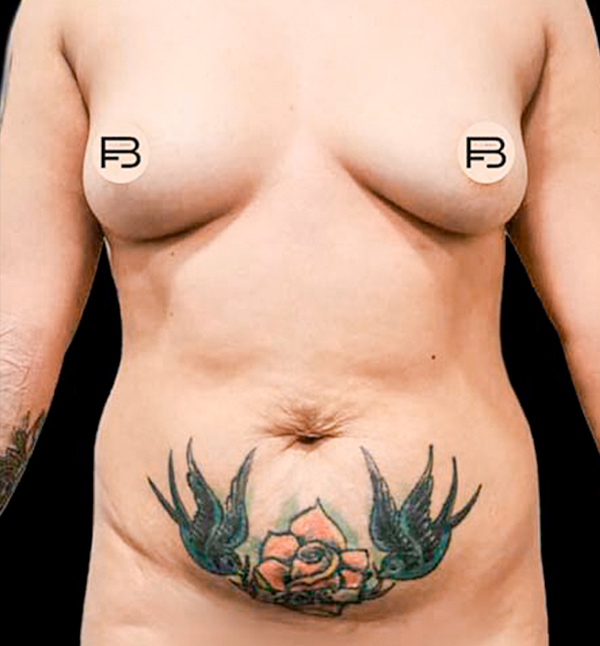 Before-ABDOMINOPLASTIA