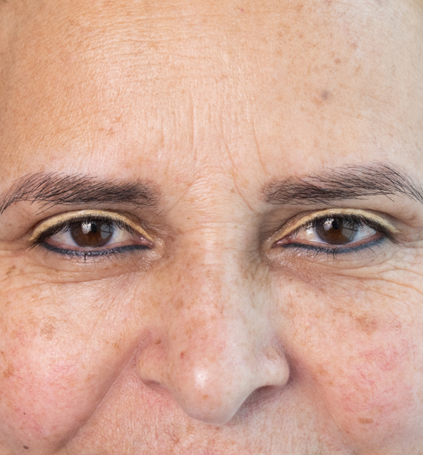 After-BLEFAROPLASTIA